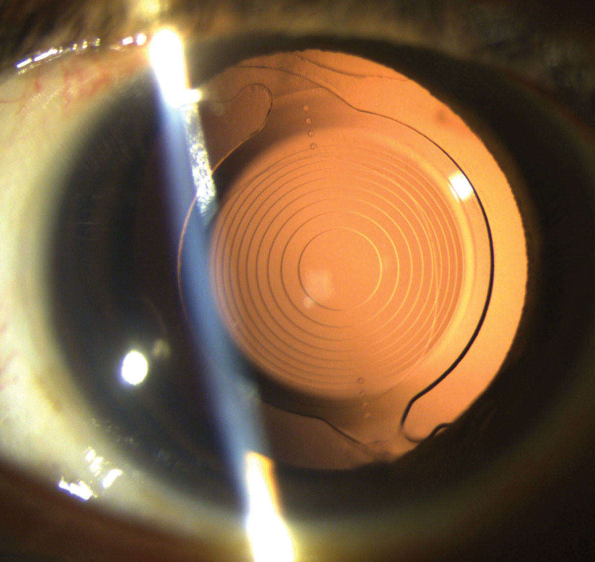 In affected patients, the induced axis change could complicate toric IOL calculations and outcomes.