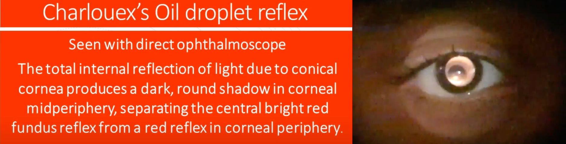 : The ADS may be a useful method to diagnose keratoconus and keratoconus-suspect cases and serve as a grading and follow-up method for tracking disease severity. Video available at www.youtube.com/watch?v=pO1PtM1oJKI