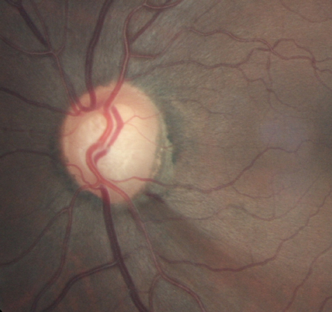 More focus should be put on implementing more frequent screening programs for glaucoma, especially since signs of the disease may present before its onset.