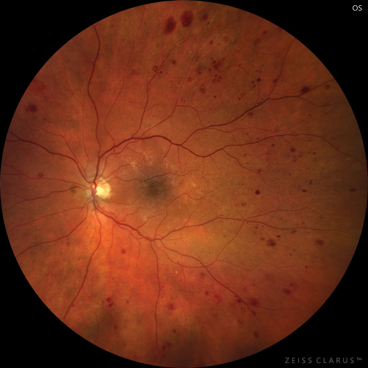 Patients with DME may have more microaneurysms detectable on OCT-A. 