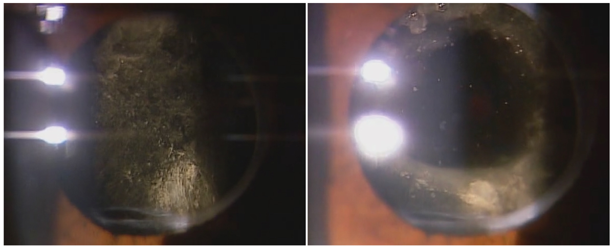 Posterior capsular distension syndrome before and after Nd:YAG capsulotomy.