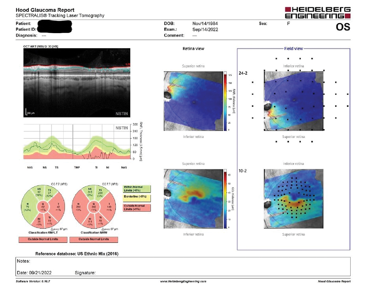 Note in the field view, to the far right in the image, the retinal thinning seen in the tilted disc on the left coincides nicely with the superimposed visual field test points, which in turn match perfectly with the results seen in the visual field study.