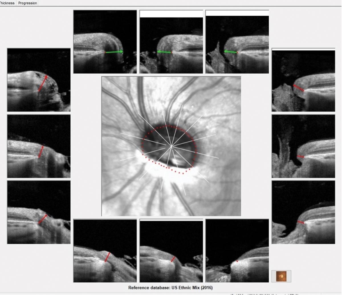 Note the inferiorly inserted approach of the optic nerve OS, as well as peripapillary atrophy visible inferiorly. In particular, note especially the significantly thin, colobomatous lack of tissue of the neuroretinal rim seen in the five o’clock representative image. The severe angle of insertion of the left optic nerve can be appreciated on the BMO-MRW printout of the left eye.