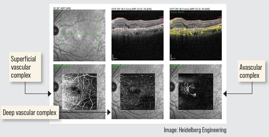 AMD patients on long-term anti-VEGF therapy may experience reduced vascular density.