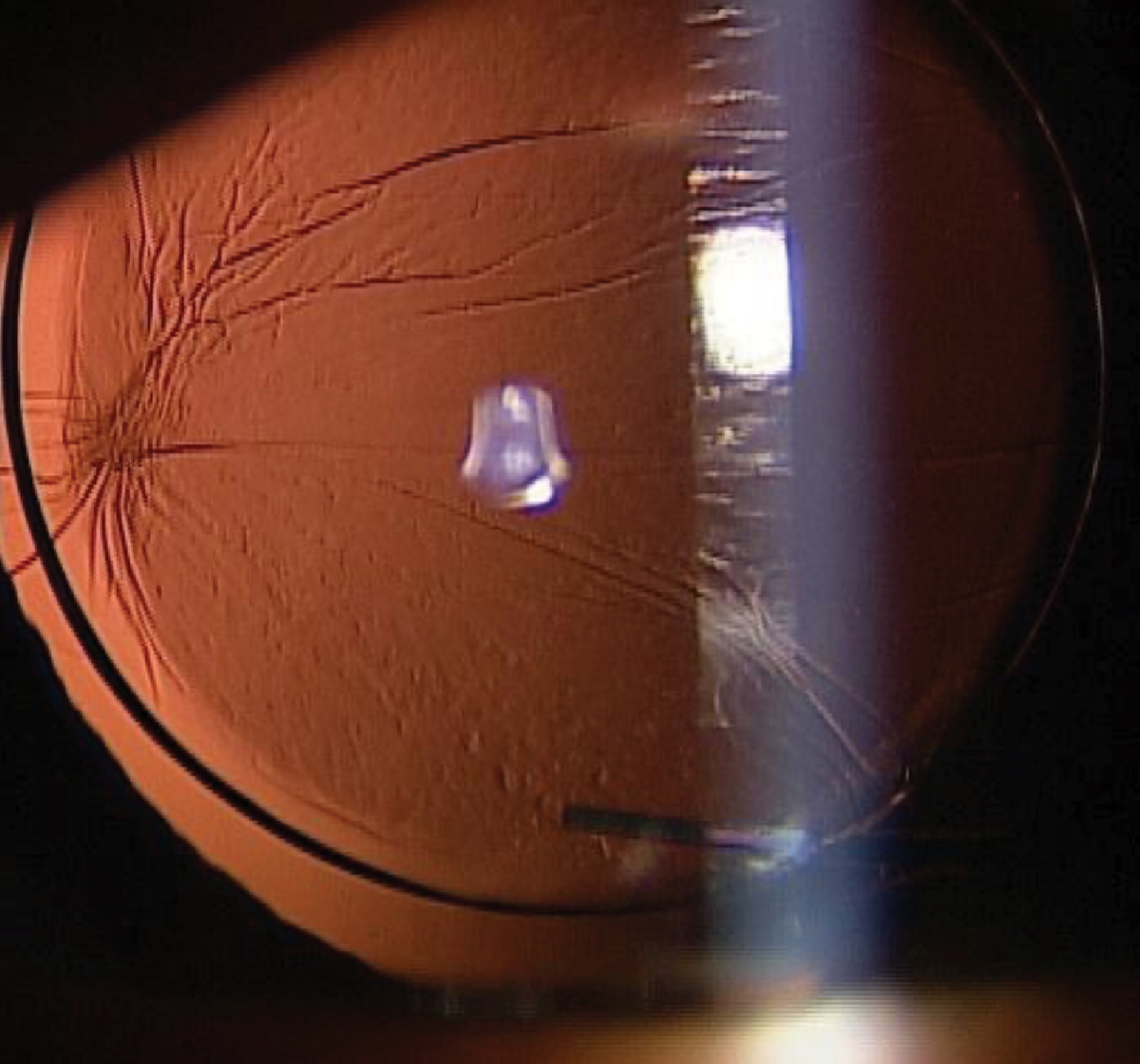 A web-based tool showed promise in acuity testing after cataract surgery, but would only provide crude assessment of visual status that could not characterize the nature of the implant’s status in a way comparable to slit-lamp exam.