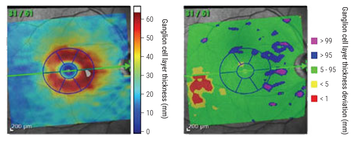 GCL thickness was more likely to demonstrate change compared with IPL in glaucoma suspects. 