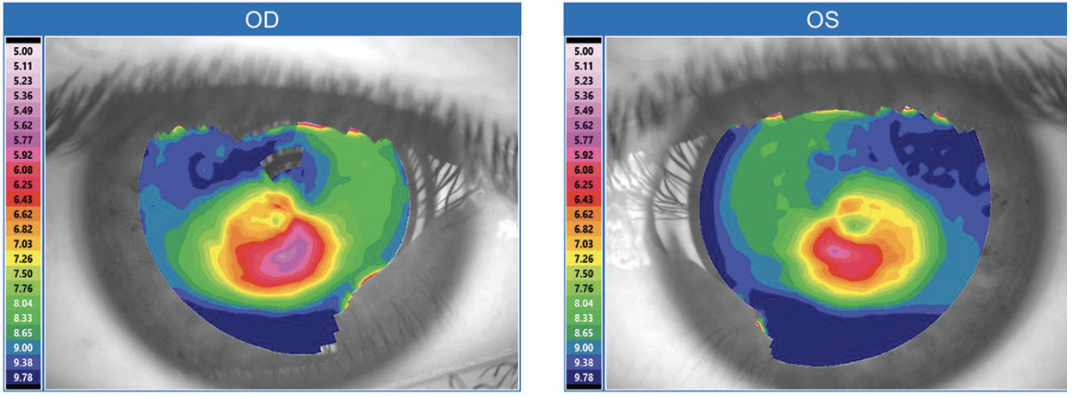 Taller people, particularly women, were found to be at a lower risk of developing steep corneas.