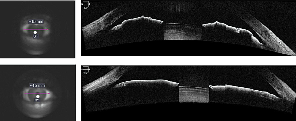 Fig. 1. AS-OCT evaluation of narrow angle (top) and open angle (bottom) using anterior segment angle-to-angle scans.