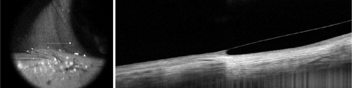 Fig. 4. Good scleral alignment of a scleral lens without impingement or lift-off.