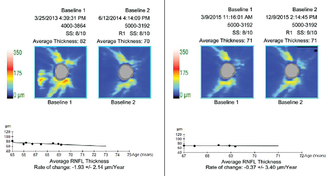 The pre-treatment rate of change (at left) is borderline fast. The re-baselined rate of change (at right) is less than age-related attrition. Re-baselining post-modification of treatment maintains an appropriate perspective and prevents over-management.