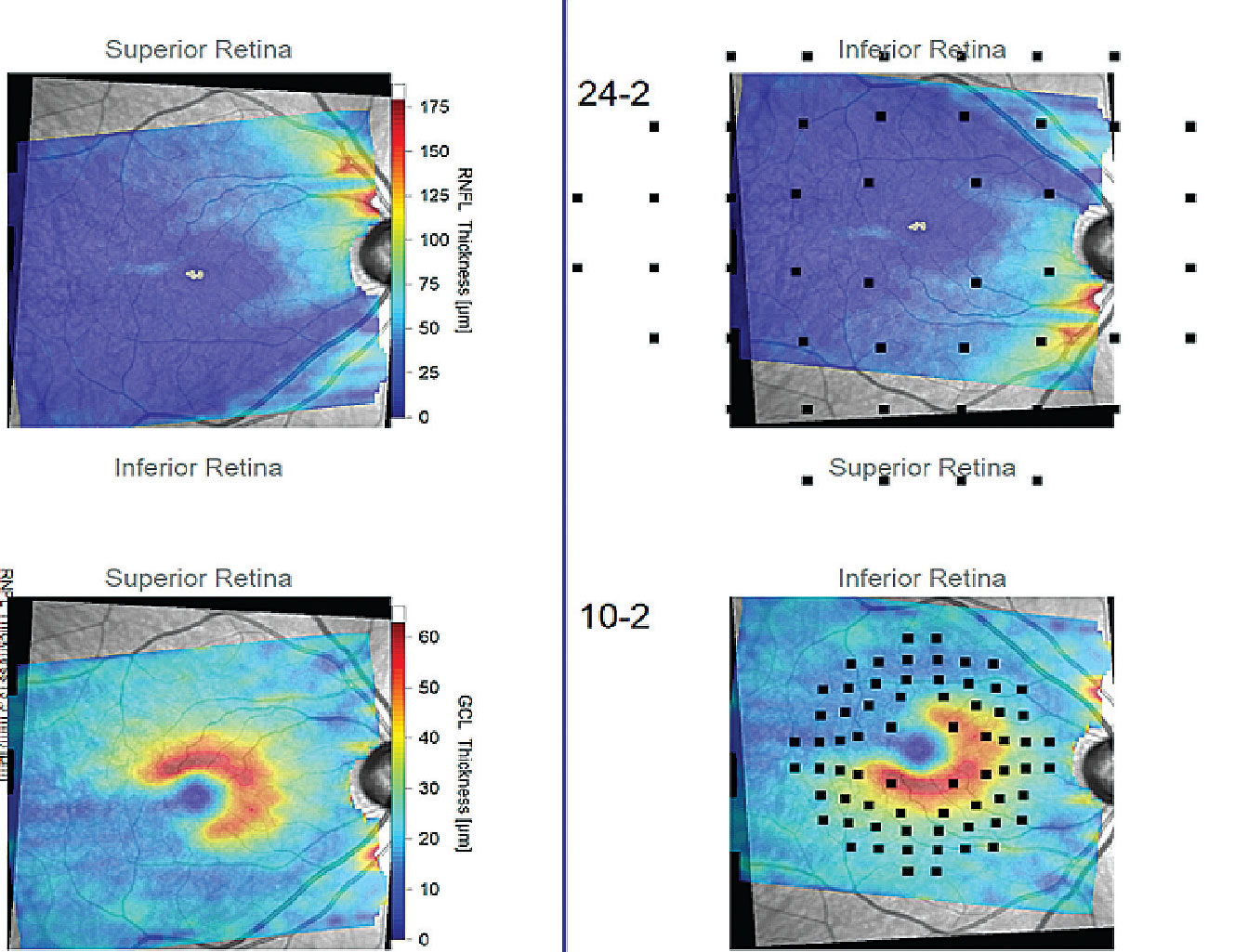 The Hood report of a patient with a wide-angle glaucomatous wedge that extends temporal past the vertical midline (black lines). These reports enhance the practitioner’s ability to topographically analyze patterns of neural tissue loss that may or may not be consistent with glaucoma.