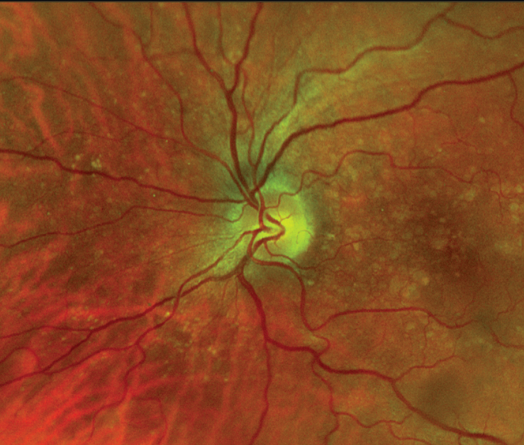 Intermediate AMD with large drusen.