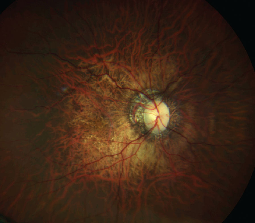 An example of degenerative myopia, which correlates more with light-colored irises.