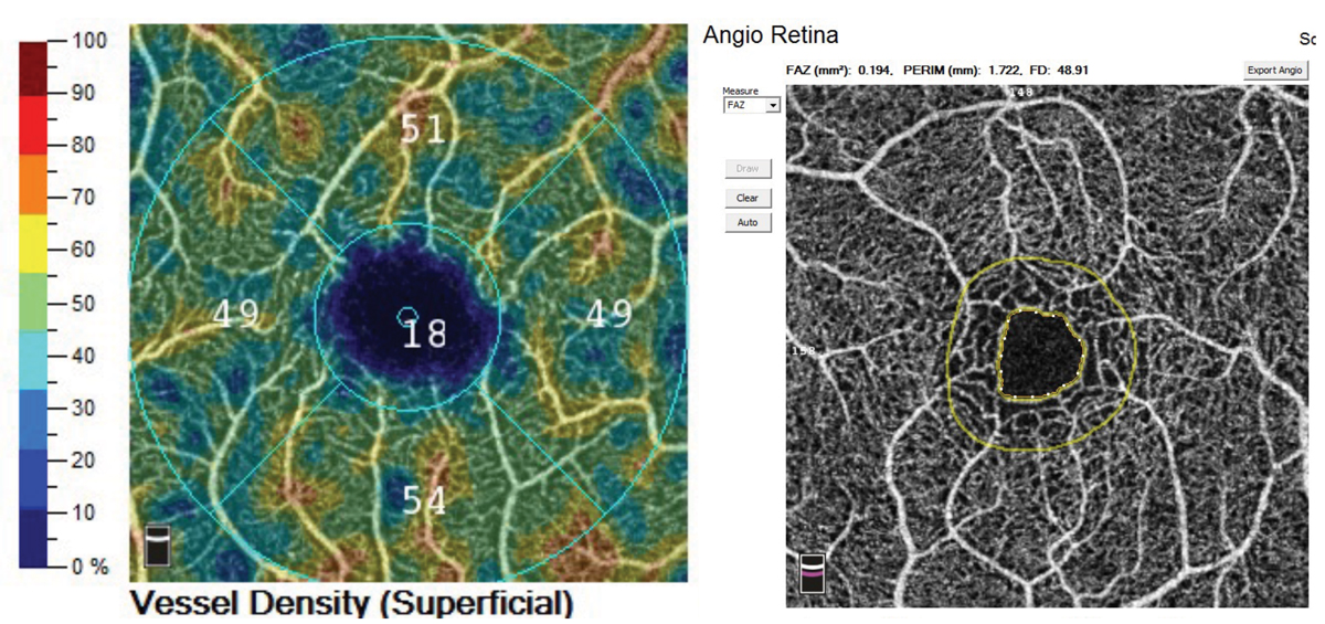 Fig. 7. The Optovue Angiovue OCT-A platform offers AngioAnalytics, a software package that computes vessel density and foveal avascular zone size that can be tracked over time.