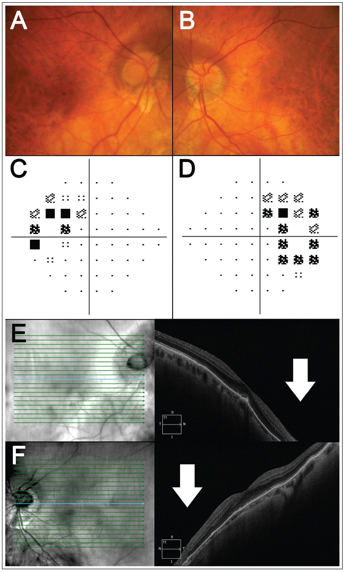 Six Questions About the Role of OCT in Neuro Evaluations