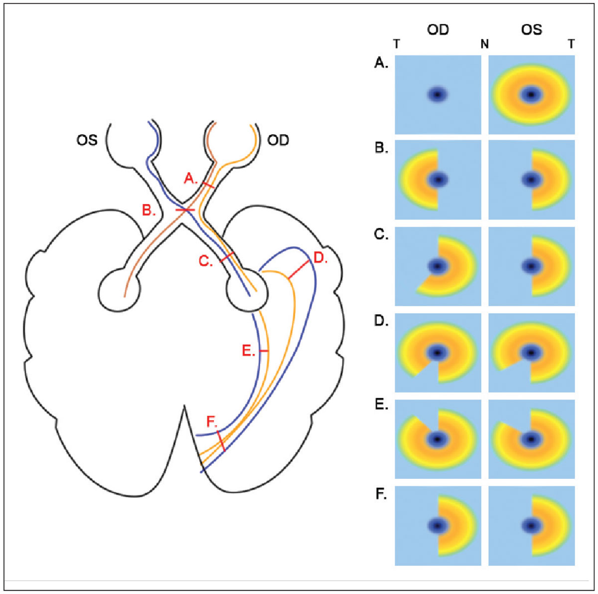 Fig. 5. A schematic of various lesions in the visual pathway and the corresponding changes in macular inner retinal OCT results. Only lesions affecting the right hemisphere are shown for brevity; for the left hemisphere, inner retinal results would be flipped horizontally. T and N denote temporal and nasal OCT locations, respectively. (A) For prechiasmal lesions affecting the right optic nerve only, global reduction in right inner retinal thickness on OCT are observed, and the left eye is unaffected. (B) For chiasmal lesions, due to decussation of nasal retinal ganglion cell axons, binasal loss in inner retinal OCTs are observed. (C) For postchiasmal lesions affecting the right hemisphere, homonymous left losses in inner retinal OCTs are noted; these may not be entirely congruent, given the relatively anterior location. (D) For lesions in the temporal lobe, homonymous superior-left defects are expected, with greater reduction in the eye ipsilateral to the lesion. (E) For lesions in the parietal lobe, homonymous inferior-left defects are expected, with greater reduction in the eye ipsilateral to the lesion. (F) For lesions of the occipital lobe that are at the primary visual cortex, homonymous left losses in inner retinal OCTs are noted.