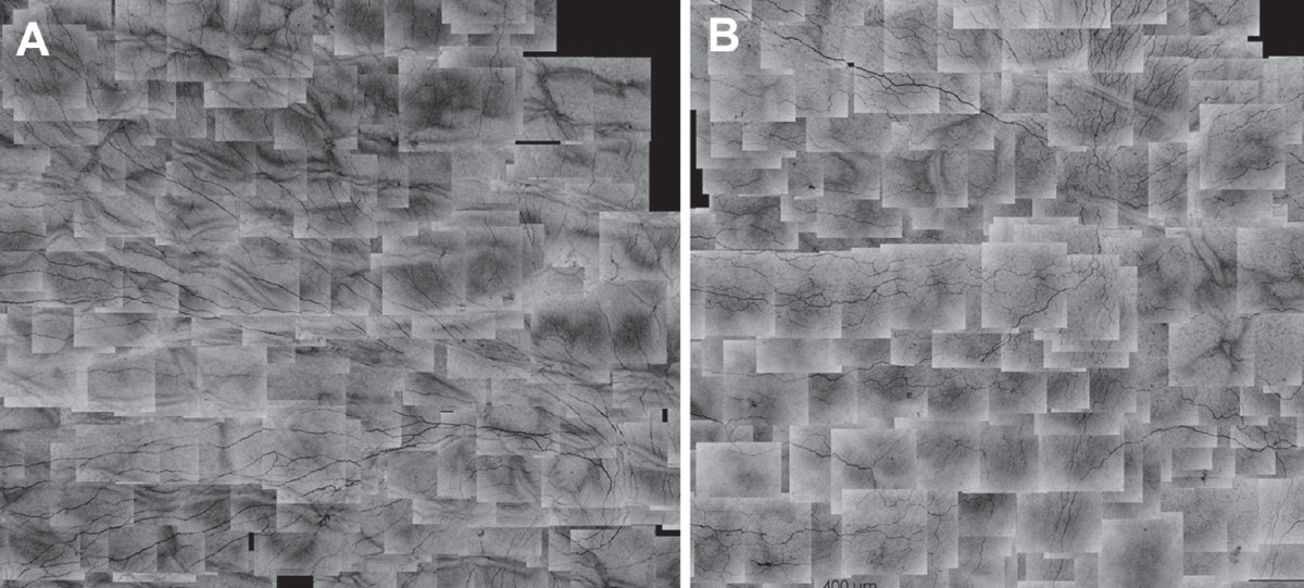 Corneal subbasal nerve map of emmetropic right eye of a normal subject (A) and right eye of another subject seven years after LASIK (B). Shown at 400mm of the scale bar.