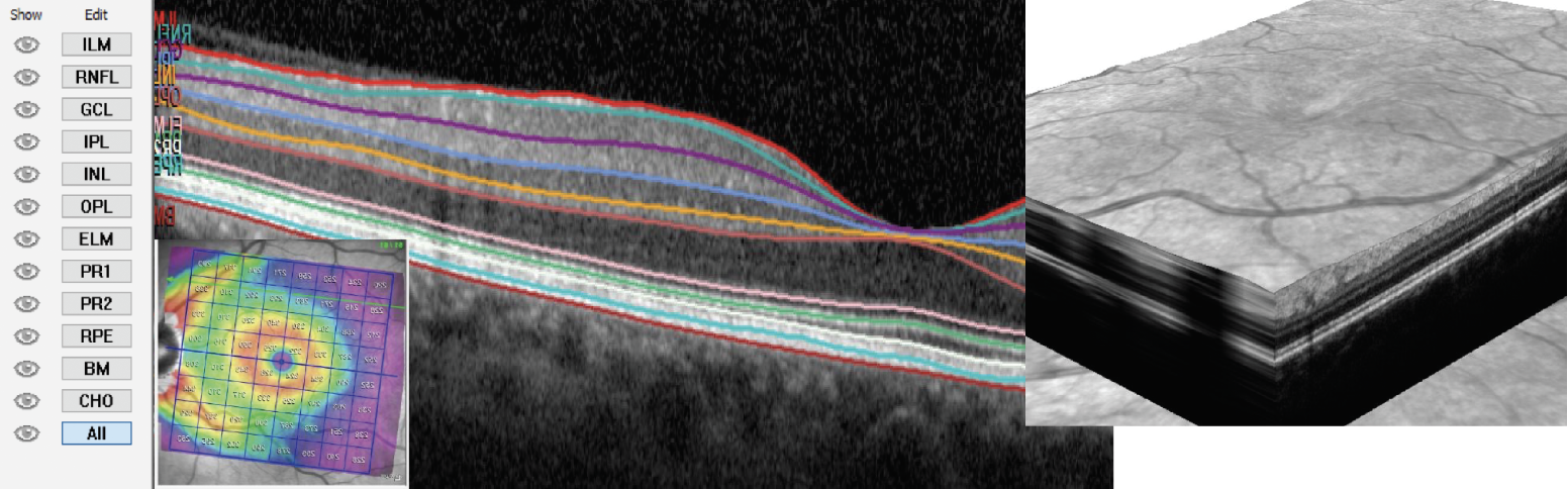 Fig. 1. OCT segmentation allows for various manipulation of images and algorithms for measurable analytics. 