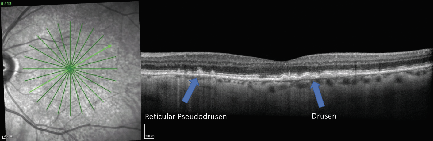 Fig. 2. A patient with both a typical drusen phenotype presenting on OCT as sub-RPE drusen deposits and RPD that present as hyperreflective deposits sitting on top of the RPE (right image). The infrared reflectance image (left) also demonstrates the reticular pattern consistent with RPD.