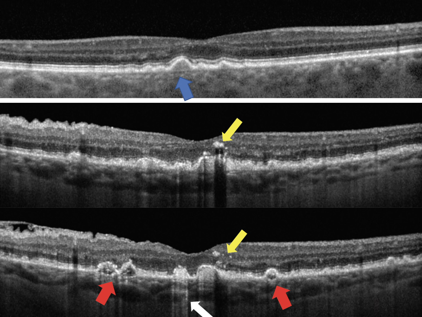 Fig. 3. The top image shows drusen with moderate, uniform internal reflectivity (blue arrow). The bottom two images show a patient with biomarkers of more advanced disease who presents with drusen of irregular, non-uniform internal reflectivity (red arrows), hyperreflective columns (white arrow) and hyperreflective foci (yellow arrows).