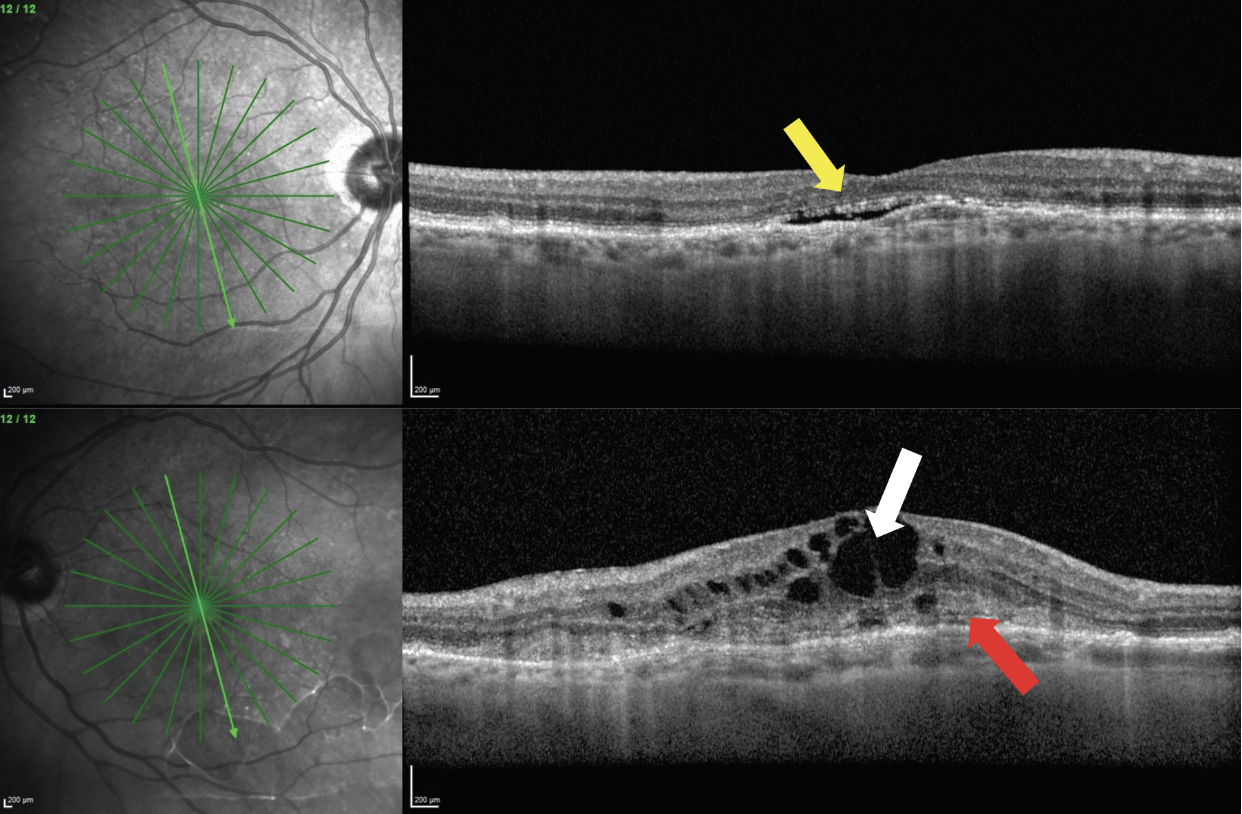 Fig. 5. A patient presents with bilateral MNV. The right eye (top images) has presence of subretinal fluid (yellow arrow). The left eye (bottom images) has intraretinal fluid (white arrow) and subretinal hyperreflective material (red arrow).