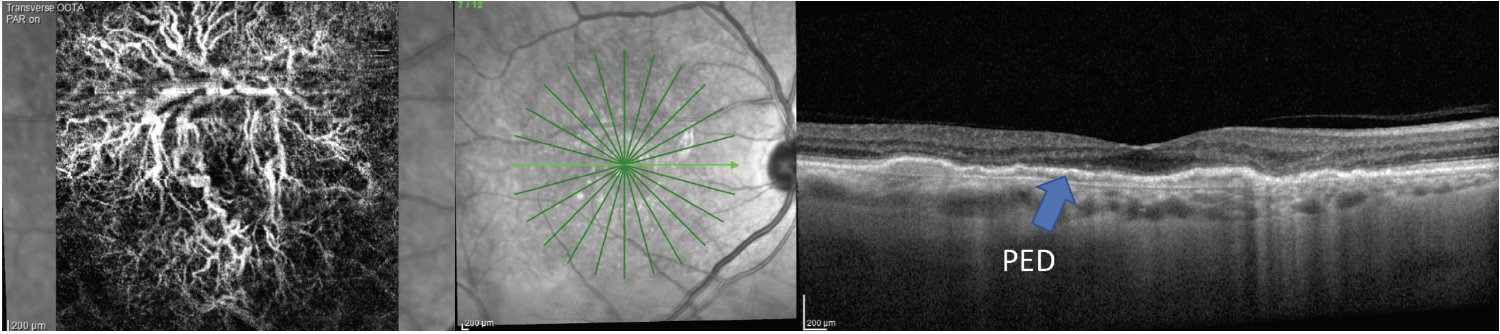 Fig. 7. AMD patient with a large, elongated PED and no sign of fluid on the OCT has an extensive MNV network present on the avascular complex of his OCT-A scan.