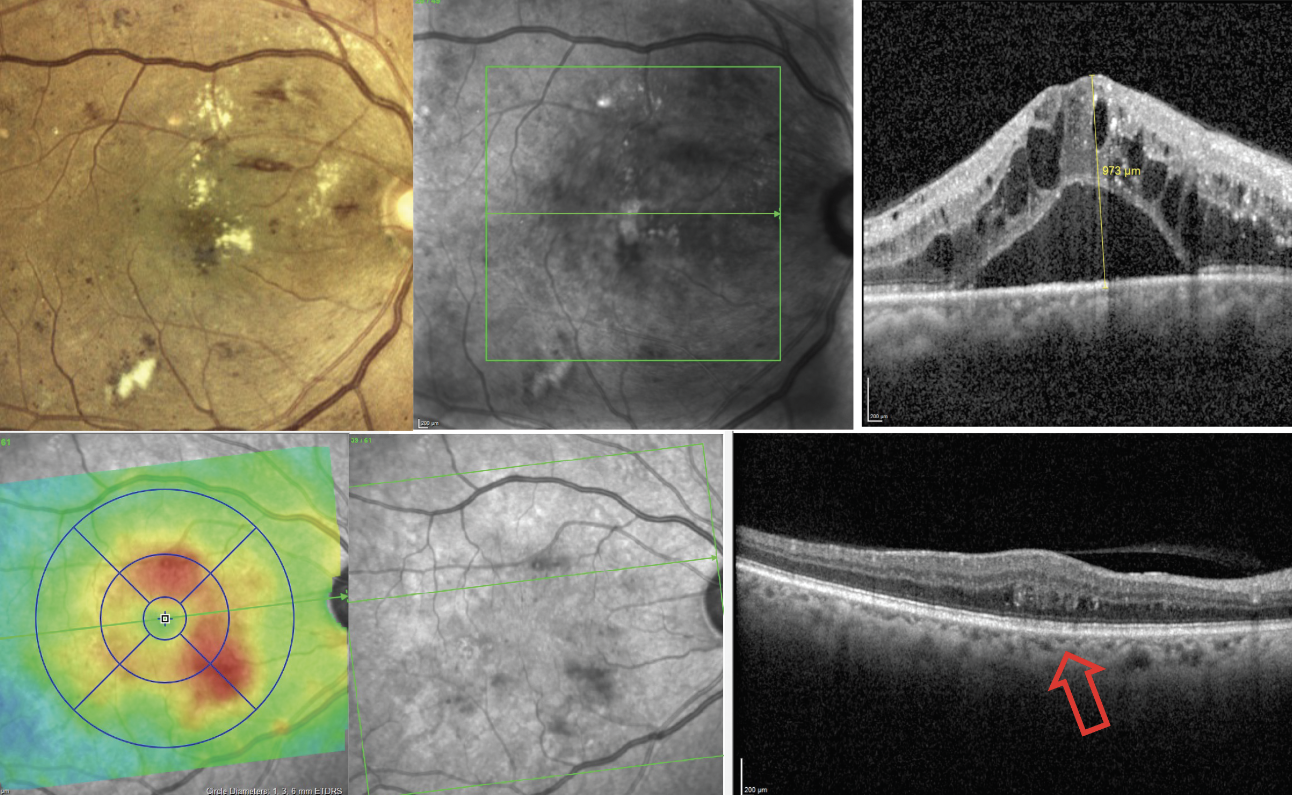 OCT: An Indispensable Tool in Retina Care