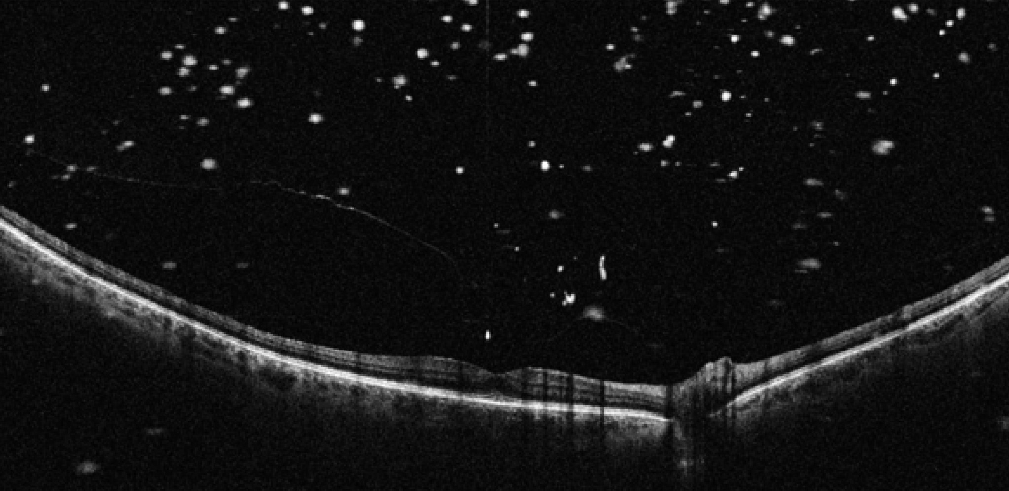 Vitreous Opacity on OCT a Telltale Sign of Retinal Tear