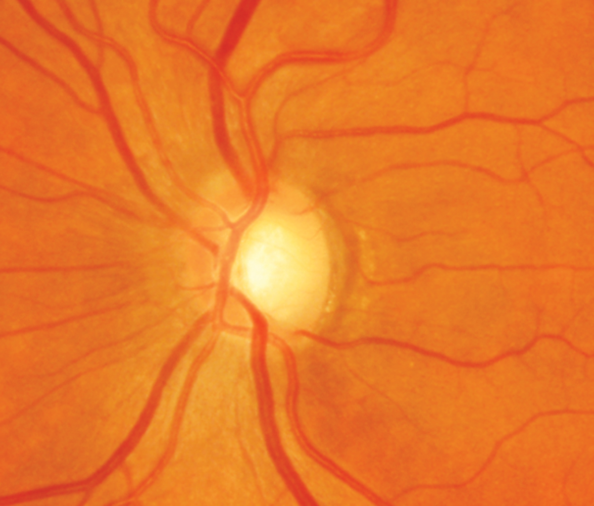 In women without glaucoma, cup-to-disc ratio was linked to lower absolute brain volume, as well as lower regional volumes in the frontal and occipital lobes. 