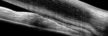 When more than half of the trabecular meshwork is obstructed by angle closure, glaucoma patients are at higher risk of IOP elevation and might require more frequent follow-up.