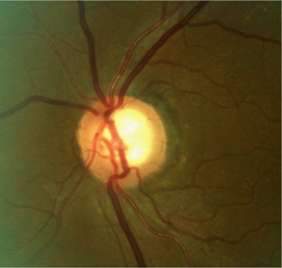 Superior temporal rim erosion and corresponding RNFL thinning in a patient with early POAG.