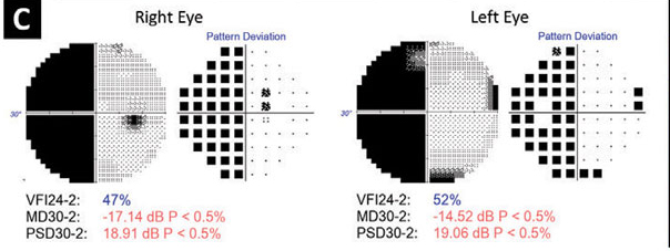 Most forms of hemianopia could potentially help determine poor functional outcome in patients who suffer from acute ischemic stroke.