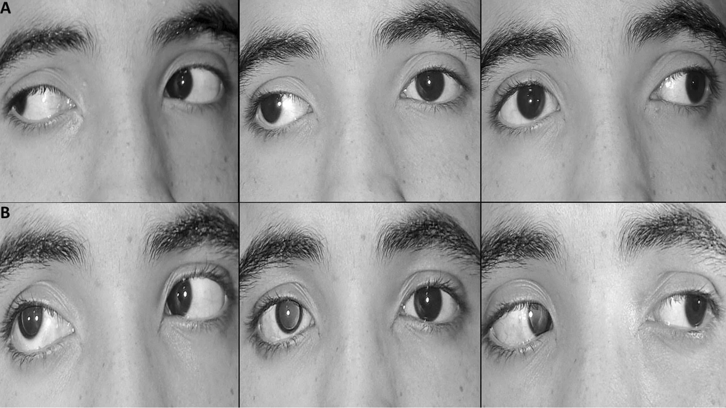 Well-controlled patients with IXT do not experience extended periods of retinal image defocus.