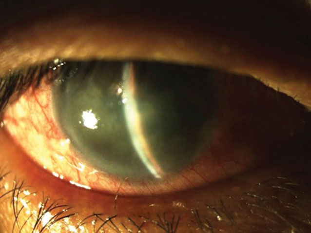 Corneal edema in an acute angle closure attack.