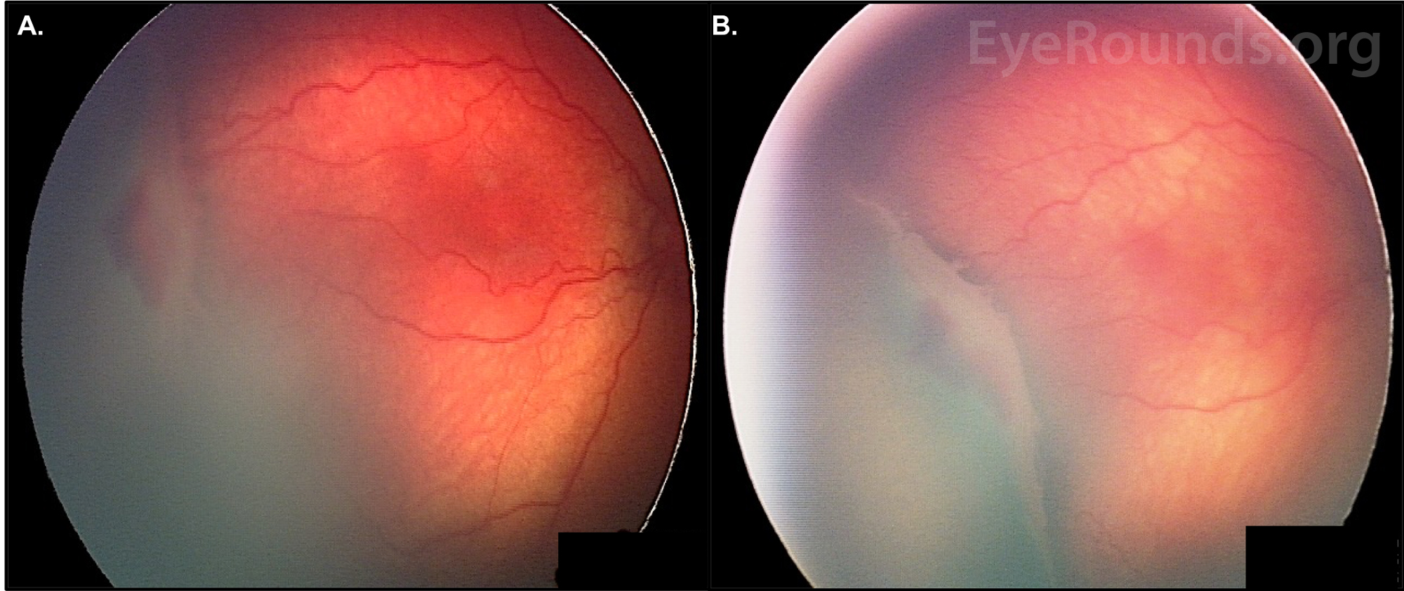 Children with ROP require continued follow-up care and vision therapy to combat potential visual impairment and other ocular problems.