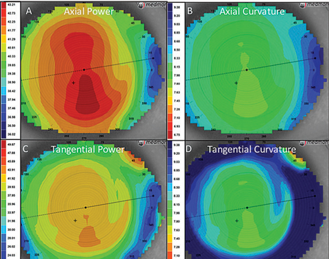 Myopia progression was found to be faster in Chinese children than Caucasian children.