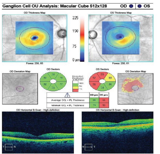 RNFL Bundle Defects, Perimetric Loss Linked in Glaucoma