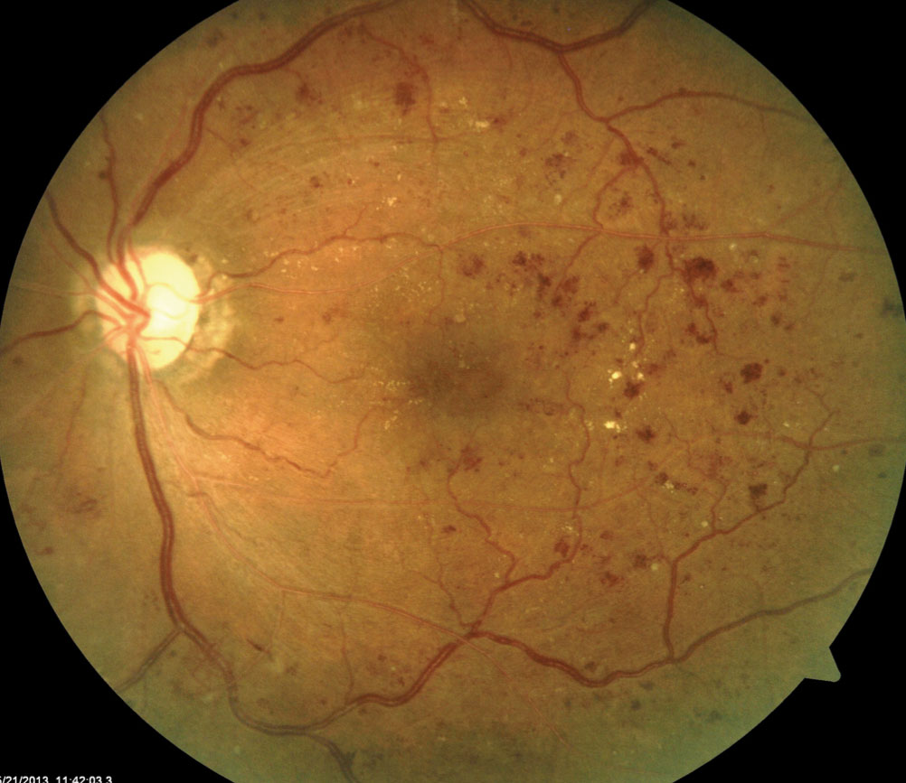 Neovascularization can be thought of as analogous to earthquakes in mechanism and pattern: catastrophic, unpredictable events.