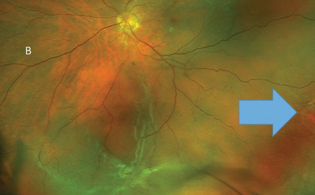 Macula-off RRDs were associated with increased risk of postoperative complications such as CME and ERM.