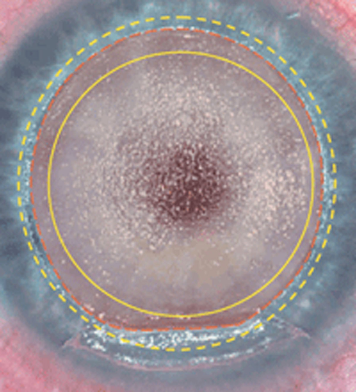 Depression and acute and pre-existing pain was found in 11% of those who experienced ocular pain after refractive surgery.