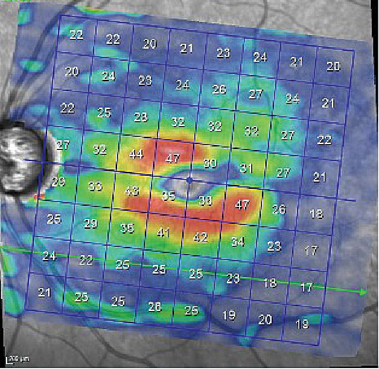 Ganglion cell layer loss just inside the inferior arcade and loss superotemporally to the foveola involving the perifoveal retina.