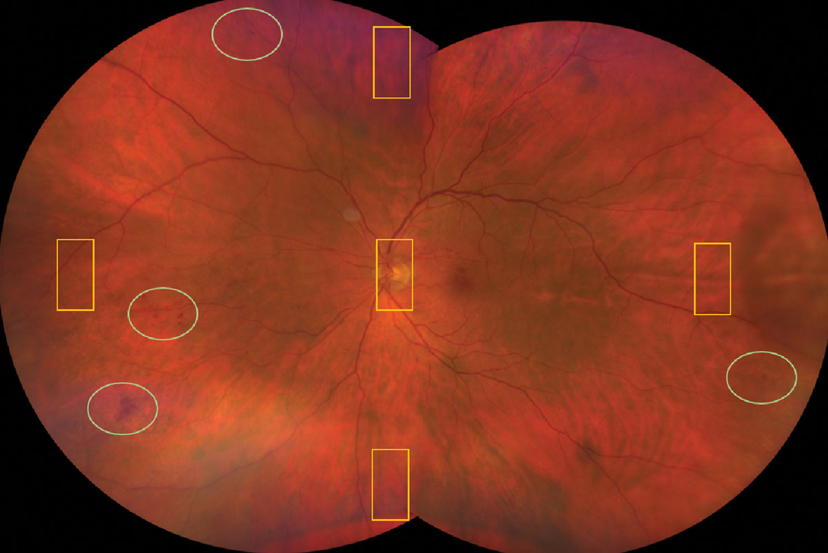 Fig. 8. The yellow rectangles are all you see if you have the patient look up, down, left and right for a peripheral exam. Notice what you’d be missing in the green ovals.