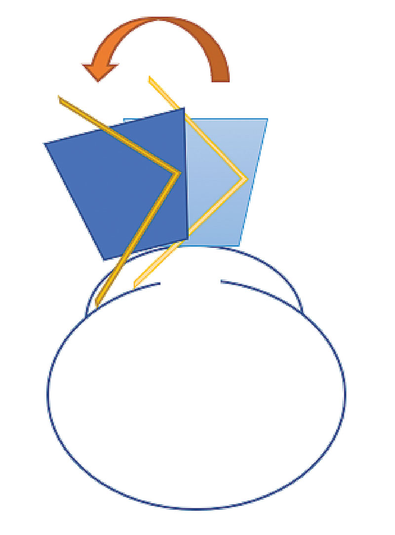 Fig. 9. Tilting the gonio lens on the cornea can adjust your view down into the angle.