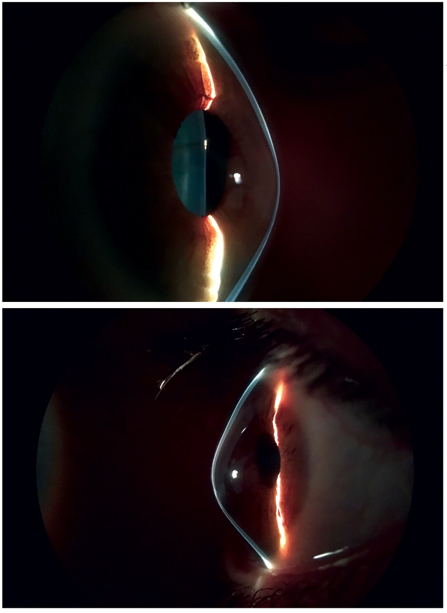 Fig. 1. Consider whether CXL has a compelling indication in a patient with Munson’s sign.