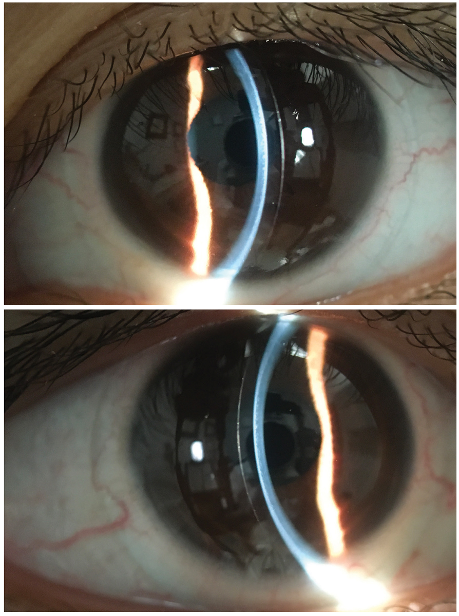 Fig. 3. Optic sections of ultrahigh Dk custom soft contact lenses for keratoconus.