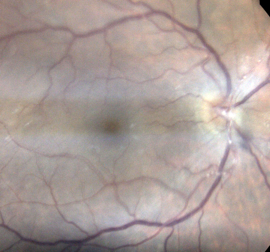 Analyzing the retinal vessels may help quantify inflammation in patients with uveitis.