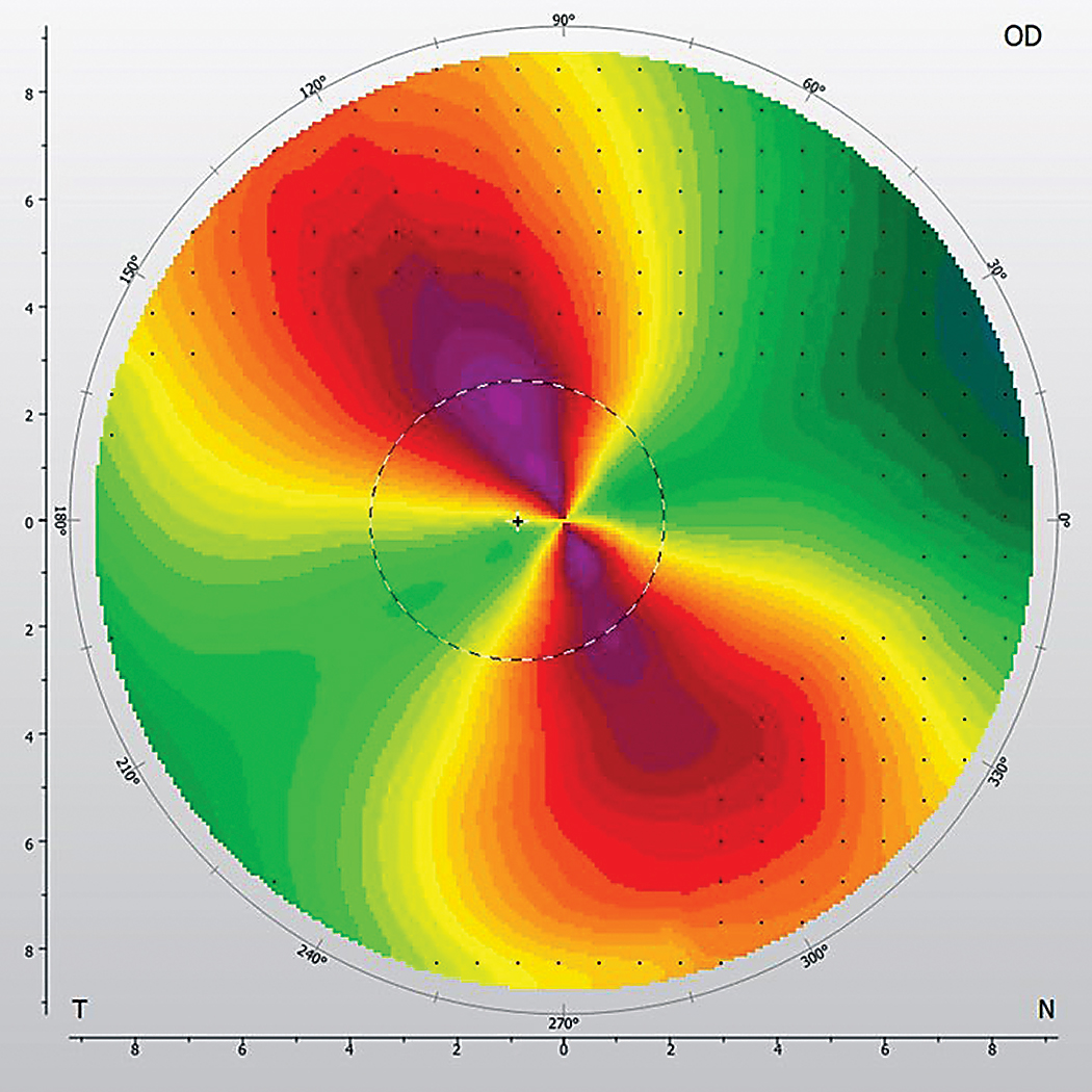 Oblique astigmatism was found to increase with age, and researchers suggest it should be fully corrected or overcorrected at the time of surgery to counteract its probable progression. 