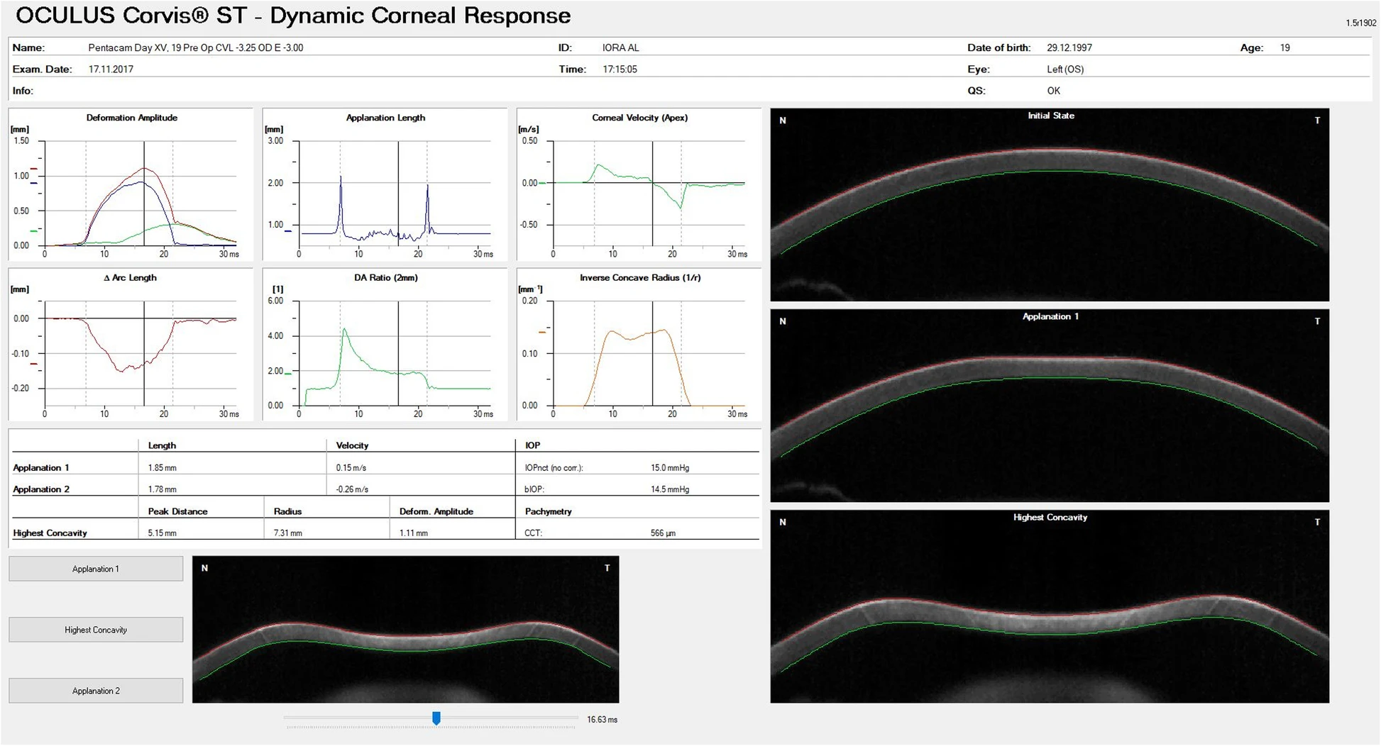 The maximum distance of corneal displacement posteriorly after a pulse of air is released, called the deformation amplitude, correlated with axial length growth and hence can help predict response to orthokeratology.