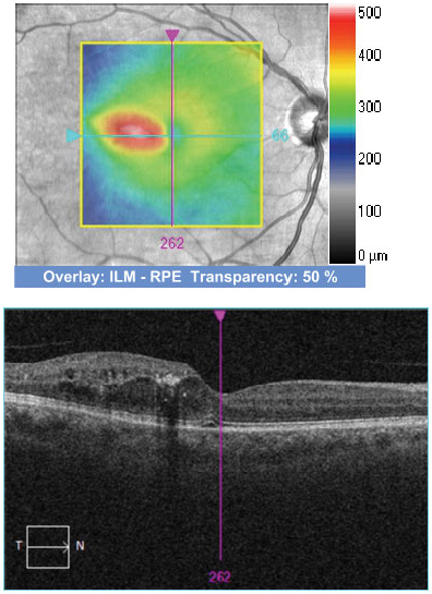 Calculating the proportion of time DME patients spend above different VA thresholds during anti-VEGF therapy may help evaluate visual outcomes over time.