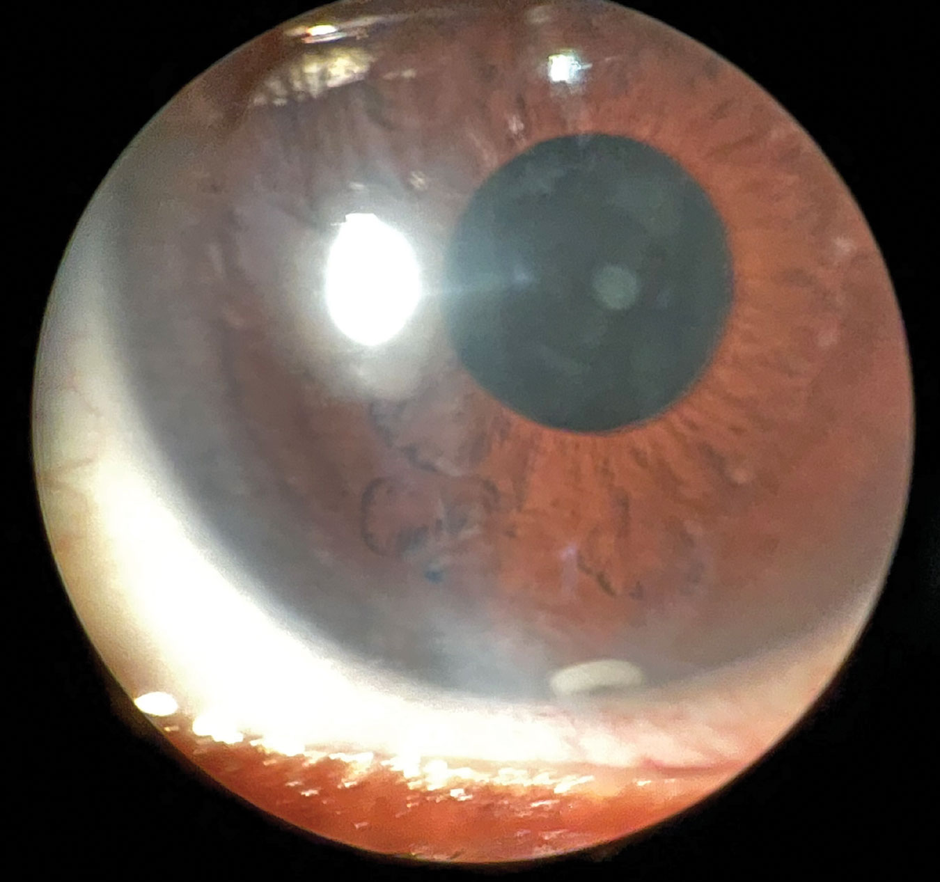 Anterior segment slit lamp photo of Durysta implant still visible at six-month follow-up.